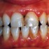 Gengivite: un problema spesso sottovalutato, che può degenerare in parodontite